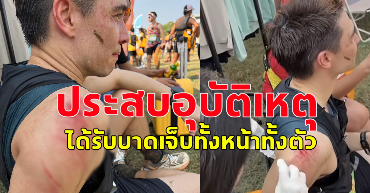 แห่เป็นห่วง แมทธิว ประสบอุบัติเหตุ ขณะไปวิ่งเทรล ได้รับบาดเจ็บทั้งหน้าทั้งตัว