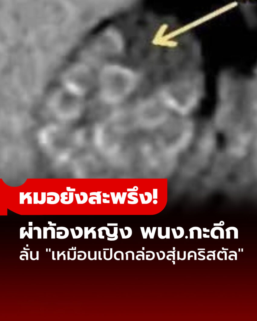 ผ่าท้องหญิง พนง.กะดึก แพทย์สะพรึง “เหมือนเปิดกล่องสุ่มคริสตัล” ขนลุกสาเหตุจากการกิน!!
