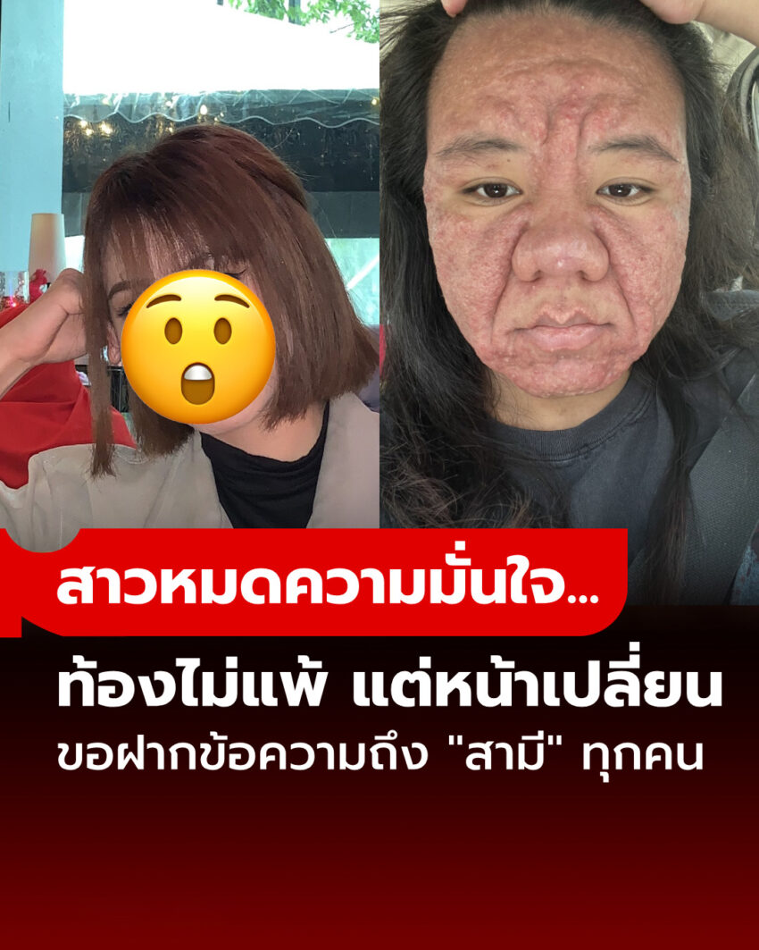 ทำใจยาก! สาวท้องไม่แพ้ แต่หน้าเปลี่ยน 100% สิ้นความมั่นใจ ฝากข้อความถึง “สามี” ทุกคน