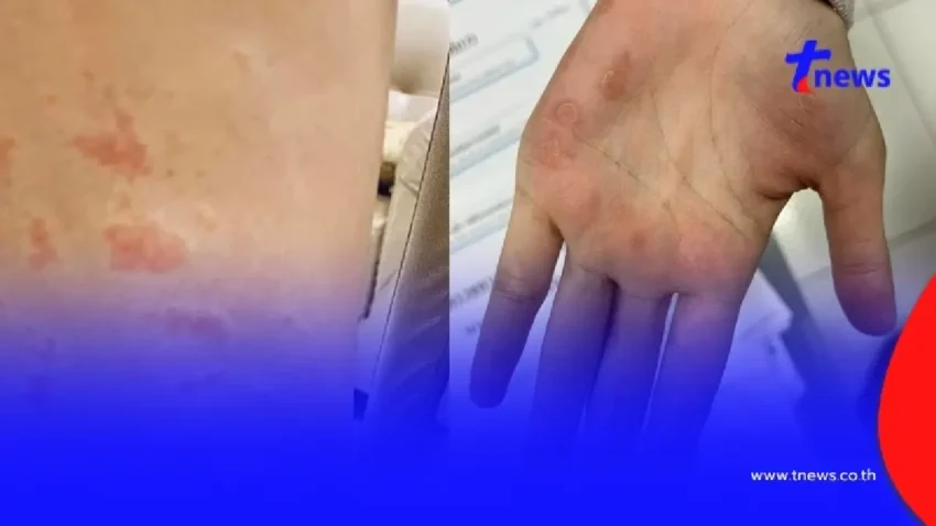 กลุ่มผู้ป่วย ซิฟิลิส – HIV สูงสุดที่มหาสารคาม ช่วงอายุน่าใจหาย