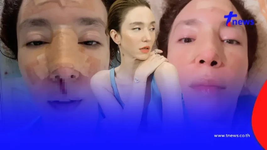 ส่งกำลังใจ ดาราสาววูบ หัวฟาดพื้น หน้าผากแตก-จมูกร้าว เย็บ 35 เข็ม