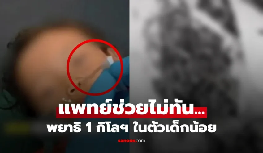 เกิดอะไรขึ้น? ไวรัลช็อก พยาธิโผล่รูจมูกเด็ก 4 ขวบ ขับออกมาเกิน 1 กิโล หมอสุดยื้อชีวิต