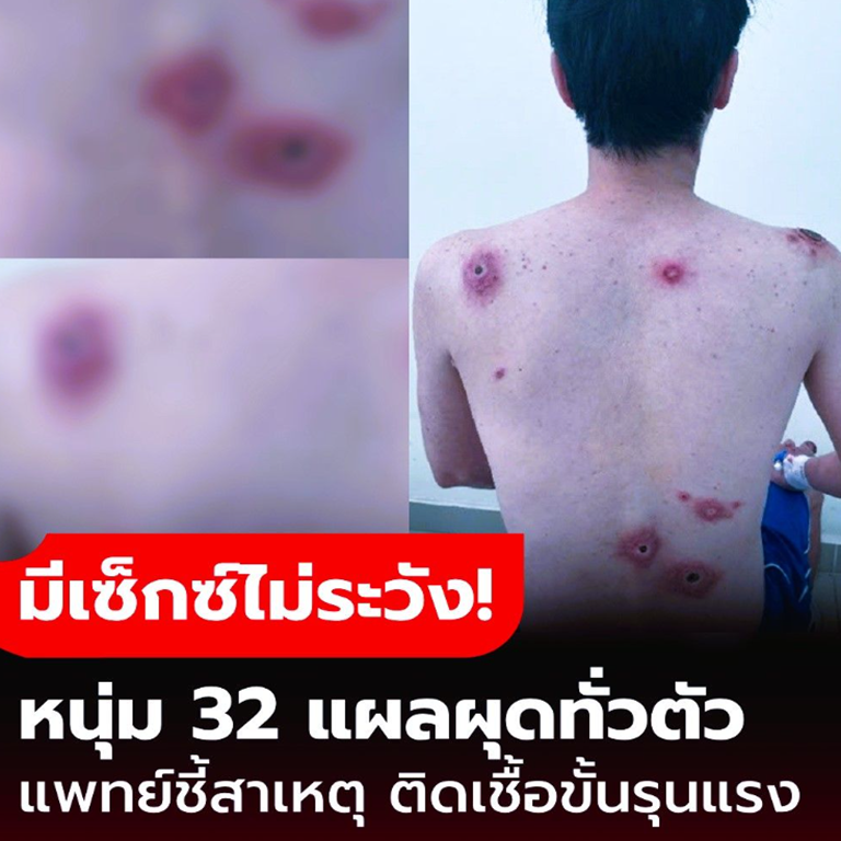 สยอง! หนุ่มออฟฟิศวัย 32 แผลผุดเต็มตัว แพทย์ตรวจพบ มีเซ็กซ์แบบ “ไม่ระวัง” คือต้นเหตุความทรมาน