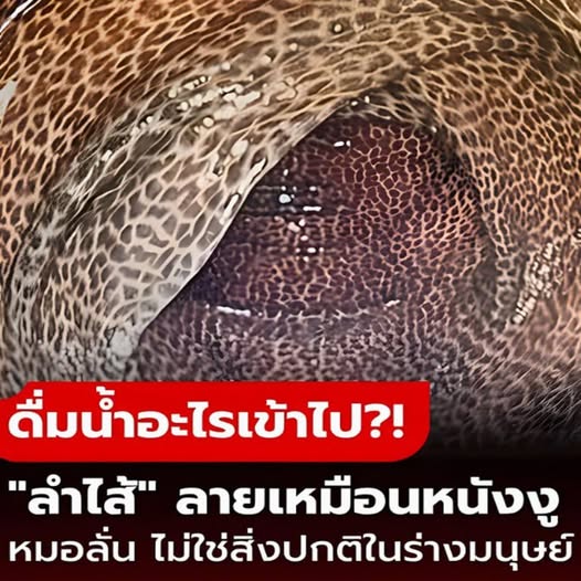 ไม่ใช่หนังงู แต่คือลำไส้มนุษย์ คนไข้เผยสิ่งที่ “ดื่มทุกวัน” หมอฟังจบรีบเตือน เสี่ยงโรคร้าย!