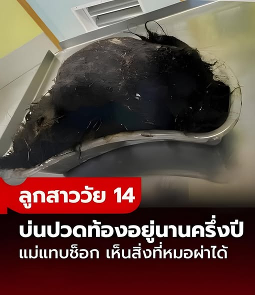 ลูกสาววัย 14 บ่นปวดท้องอยู่ครึ่งปี แม่สุดช็อก เมื่อเห็นสิ่งที่หมอผ่าออกจากกระเพาะ